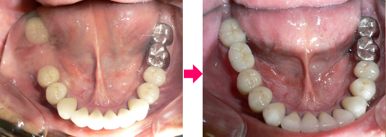 （写真）左下第1大臼歯 診療前後の比較