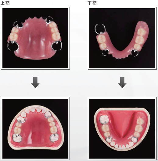 （写真）レジン床義歯(保険治療)