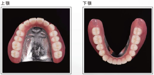 （写真）金属床義歯(自費治療)