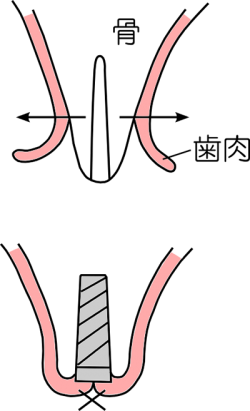 スプリットクレスト（歯槽堤分割法）